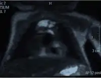 Chest MRI showing a hemothorax in a 16-day-old infant