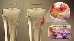 3D Medical Animation still shot of Osteomyelitis bone