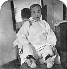 A Chinese woman shows the effects of foot binding on her feet.