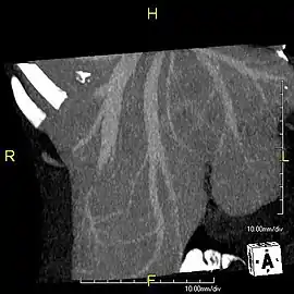 Maximum intensity projection (MIP) CT image as viewed anteriorly showing the anomalous hepatic veins coursing on the anterior surface of the liver