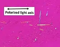 Uric acid crystals in polarized light, showing negative birefringence, with yellow color when aligned parallel to the axis of the red compensator, and blue when aligned perpendicularly to it.