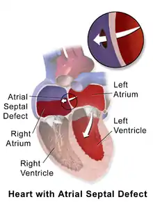 Illustration depicting atrial septal defect