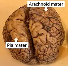 Brain with arachnoid mater, and an area where it is removed, showing cerebral gyri covered by the translucent pia mater.