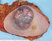 A large invasive ductal carcinoma in a mastectomy specimen