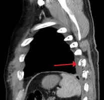 Two broken ribs as seen on parasagittal CT