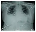 Acute interstitial pneumonia showing a marked reduction in lung capacity