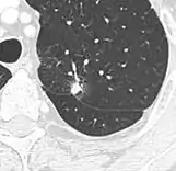 Nodule with pleural retraction.