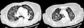 CT, 16 days after onset, showing extensive pulmonary parenchymal involvement consisting of irregular septal thickenings with ground-glass areas and centrilobular nodules with a peri-lymphatic distribution