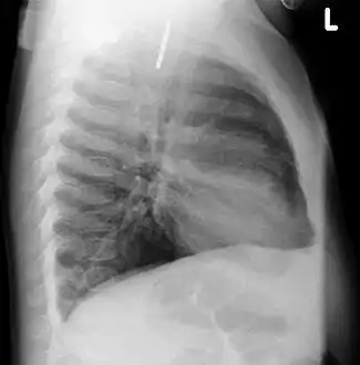 A coin seen on lateral CXR in the esophagus