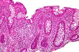 Focal cryptitis and a granuloma. H&E stain.