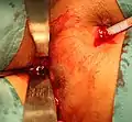 Curette from External opening