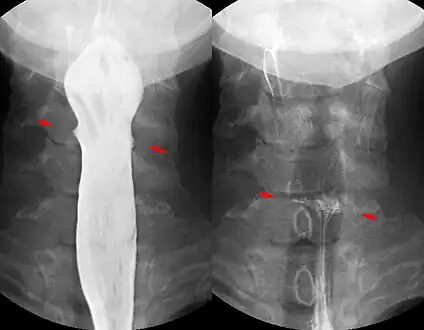 Fishbone pierced in the upper esophagus.Left image during swallowing contrast medium, right image after swallow only dimly visible.