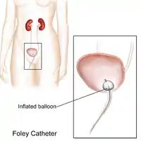 Foley Catheter Illustration