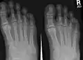 X-ray of foot, showing phalangeal fracture