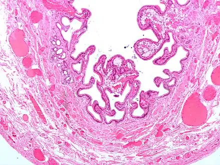 Micrograph of cholesterolosis of the gallbladder