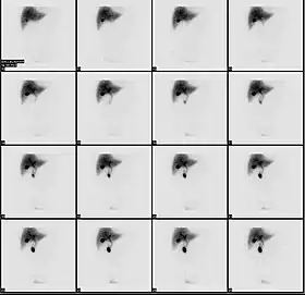 Normal hepatobiliary scan (HIDA scan). The nuclear medicine hepatobiliary scan is clinically useful in the detection of the gallbladder disease.