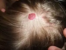 Hemangioma on the scalp of a 2-year-old child, in the "rest stage"