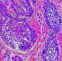 Nests: islands of cells of similar type.