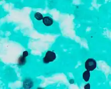 Histopathology of Histoplasma capsulatum, GMS stain, showing narrow budding yeast