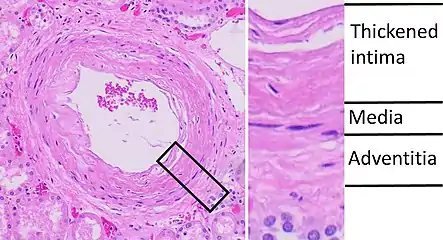 Histopathology of arcuate artery nephrosclerosis, seen as a thickened intima with an onion skin-like architecture. It is presumably a manifestation of hypertensive kidney disease.