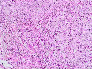 Invasive squamous cell carcinoma of the cervix is characterized by infiltration as irregular anastomosing nests or single cells. This case is poorly differentiated. H&E stain.