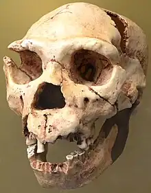 A skull with jaw missing its lower incisors and canines, and all of its upper teeth except for one incisor and its molars, and a broken right brow ridge