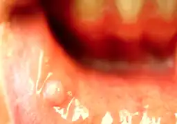 Photo of irritation fibroma on the labial mucosa.