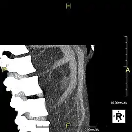 Lateral MIP view in the same patient as previous image