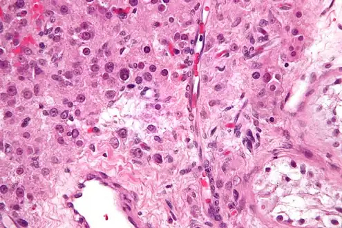 Micrograph of a Leydig cell tumour