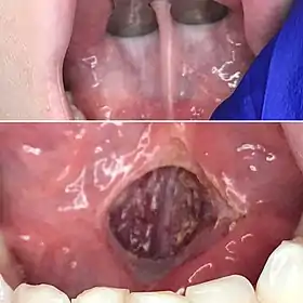 Laser Lingual Frenectomy