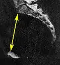 Obstetric conjugate, as a measure of the pelvic inlet in the sagittal plane