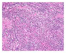 Low power view of IgG4-related prostatitis