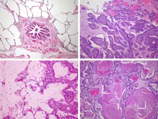 Microscope images of lung tissue. At top-left, healthy lung with clear air-filled alveoli. Others are full of tumor or material, per caption.