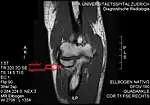 T1 weighted MRI showing the anular ligament