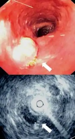 Endoscopy and radial endoscopic ultrasound images of a submucosal tumor in the central portion of the esophagus