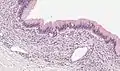 Mucinous cystadenoma of the pancreas