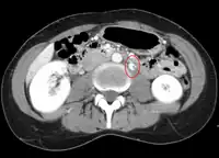 Thrombosis in the left renal vein associated with dilation