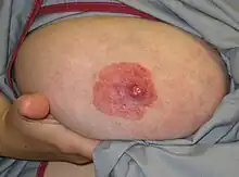 Paget's disease of the nipple