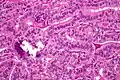 Micrograph of papillary thyroid carcinoma, tall cell variant - high magnification. H&E stain.