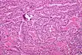 Micrograph of papillary thyroid carcinoma, tall cell variant - intermediate magnification. H&E stain.