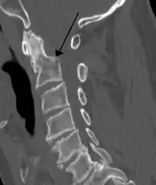 A fracture of the base of the dens as seen on CT