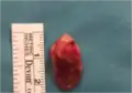 Excised pilonidal cyst