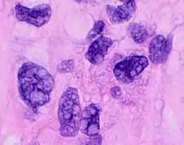 Pleomorphic when having different sizes and shapes. This often correlates with an increased nucleus to cytoplasm ratio. These features generally indicate malignancy.