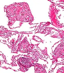 A foreign-body response to talc (talcosis) due to intravenous drug use. H&E stain.