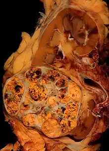 Clear-cell renal-cell carcinoma. Macroscopy