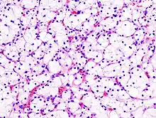 Clear-cell renal-cell carcinoma. Fuhrman grade = 1. HE, × 400