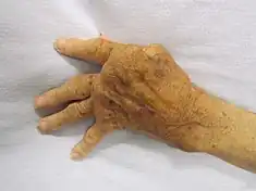 photograph of elderly hand depicting advanced rheumatoid arthritis