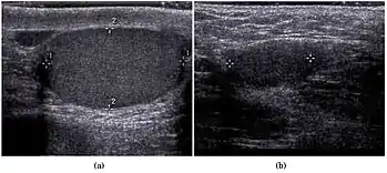 Fig. 29. Undescended testis. (a) Normal testis in the scrotum. (b) Atrophic and decreased echogenicity of the contralateral testis of the same patient seen in the inguinal region.[citation needed]