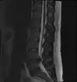 A rather severe herniation of the L4–L5 disc