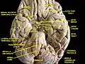 Cerebrum.Inferior view.Deep dissection.